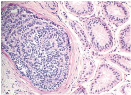 A.focal Sertoli cell hyperplasia