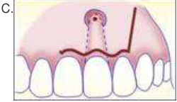 submarginal incision with triangular flap