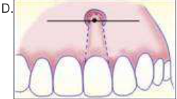 vestibular incision with fistulectomy