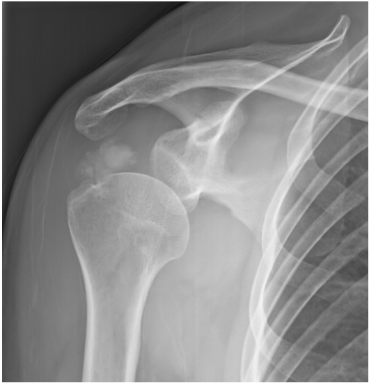 A.calcified tendinosis