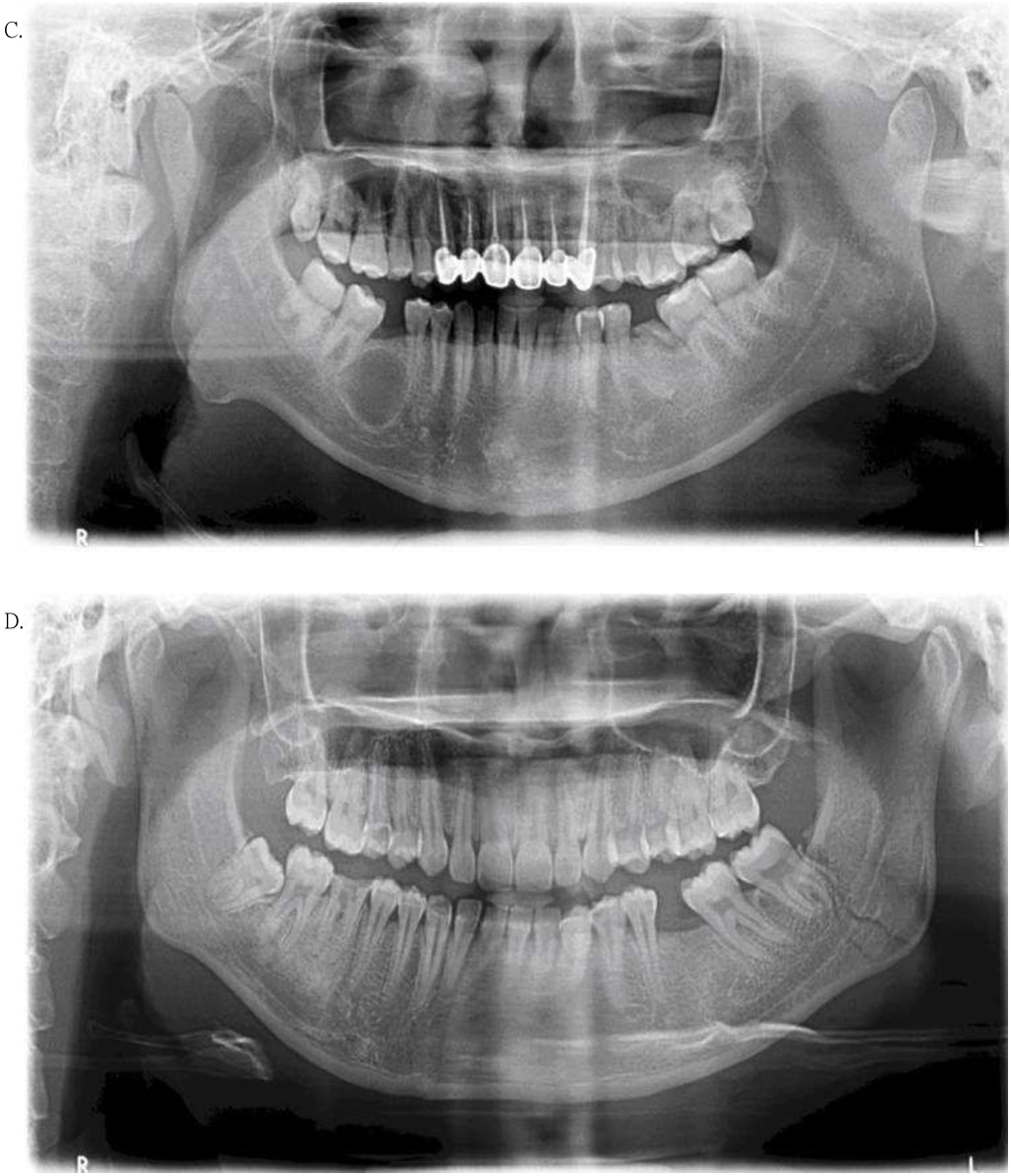 68.下列何者最可能為鎖顱骨成骨不全(cleidocranial dysostosis)之影像?