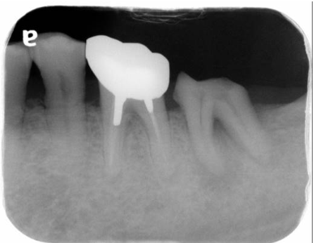 A. 牙髓壞死( pulp necrosis )合併正常根尖組織( normal apical tissue )