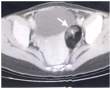  異位性妊娠( ectopic pregnancy ) 卵巢癌( ovarian cancer )