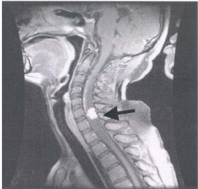  Von Hippel-Lindau disease