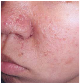  tuberous sclerosis