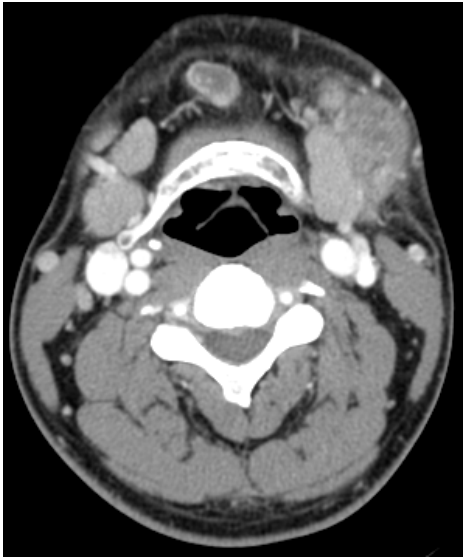  tongue carcinoma