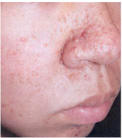  systemic sclerosis