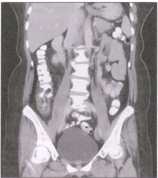  大腸癌( colon cancer ) 急性闌尾炎( acute appendicitis