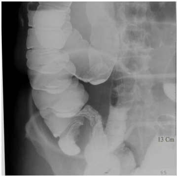  大腸鏡（ colonoscopy ）