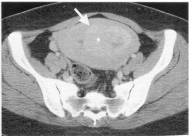  卵巢皮樣囊腫（ dermoid cyst ）  子宮類纖維瘤（ uterine fibroid or leiomyoma ）