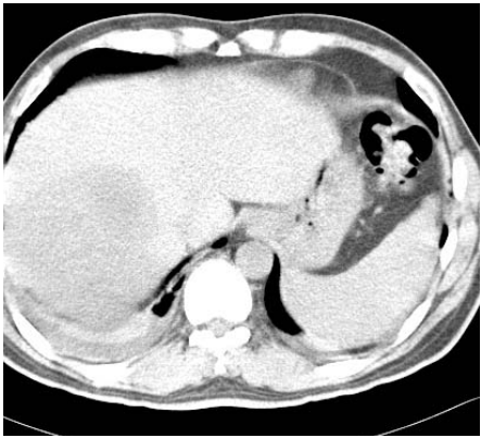  肝臟海綿狀血管瘤（ cavernous hemangioma ）  局部性脂肪肝（ focal fatty infiltration ）