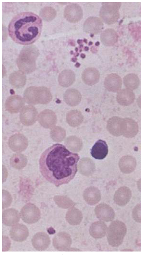  皮肌炎（ dermatomyositis ）  柏哲德氏病（ Paget's disease ）