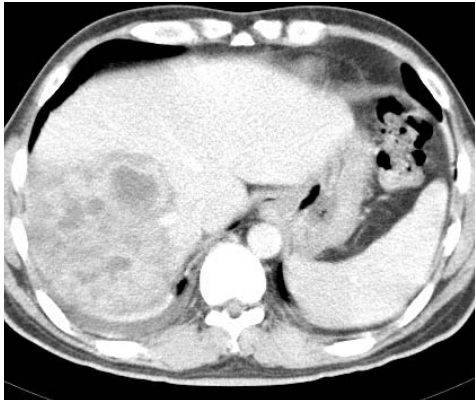  肝膿瘍（ liver abscess ）  轉移病變（ liver metastasis ）