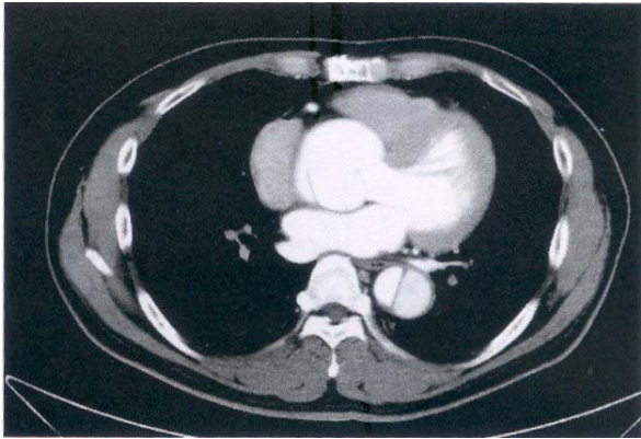  食道癌  左心房黏液瘤（ Left atrial myxoma