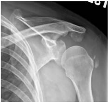 A.avulsion fracture of greater tuberosity