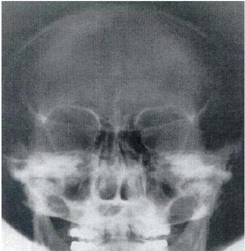 A.SMV （ submentovertex ） projection