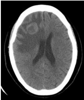 A. 出血性中風( hemorrhagic stroke )