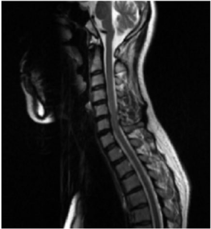 A. T-spine sagittal view FSE-T1 weighted