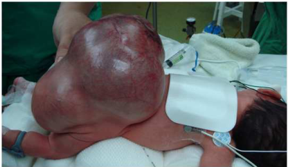A. 最可能的診斷為薦尾椎畸胎瘤( sacrococcygeal teratoma )