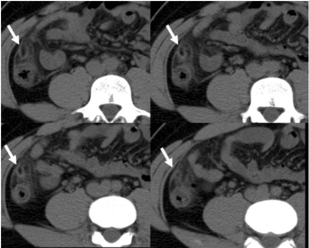 A.epiploic appendagitis