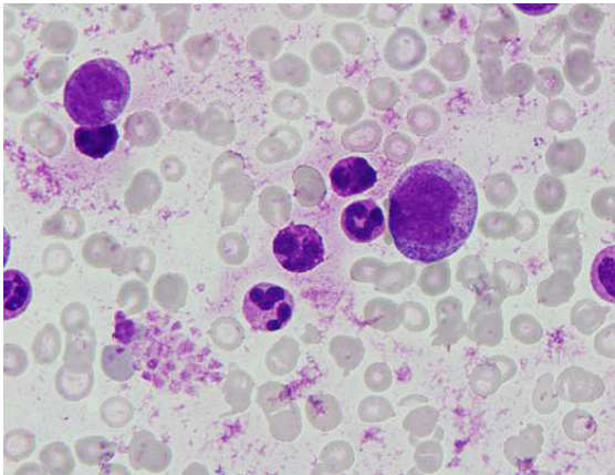 A. 現在治療此病的第一線藥物是 tyrosine kinase inhibitors ,例如 imatinib 、 dasatinib 或是 nilotinib