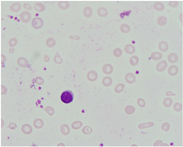A. 此類病⼈的⾎液中的 reticulocyte counts 常是降低的