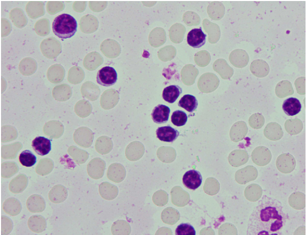 A. 典型的周邊⾎液抹片常出現 basket cells 或 smudge cells