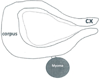  Type 3