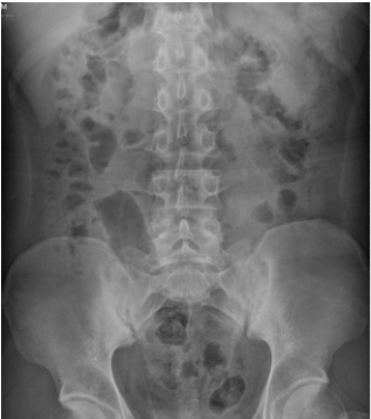  脊柱退行性病變( Degenerative Spondylosis ) 椎間盤突出