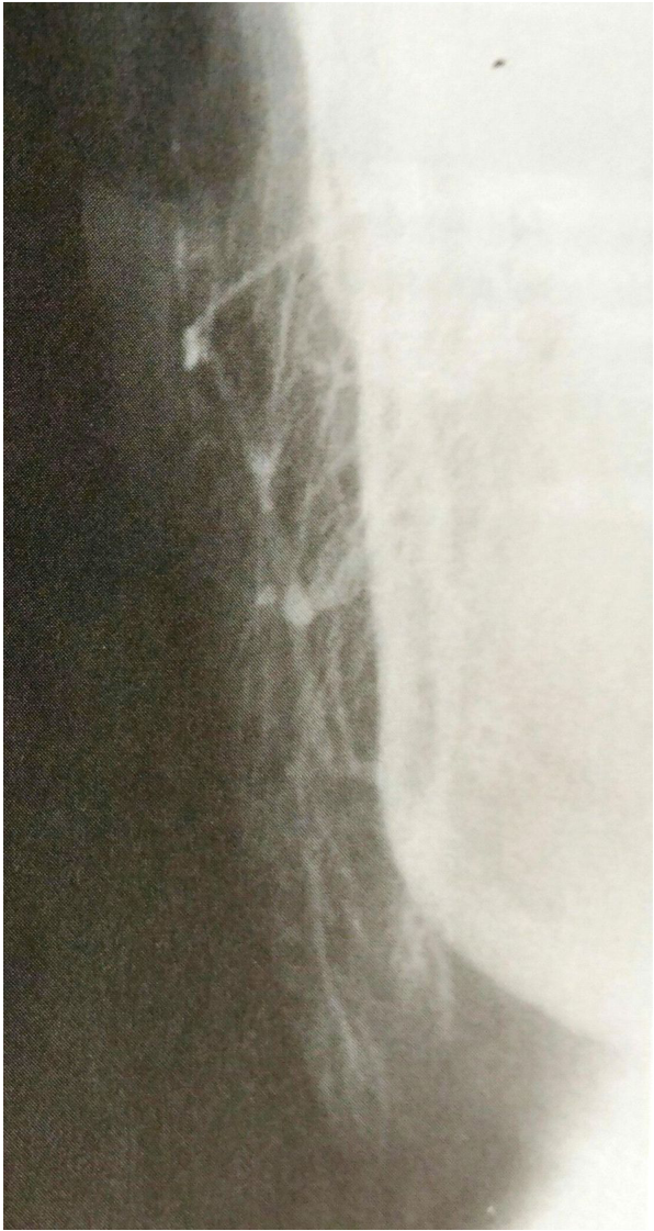 71. 下列何者符合地中海型貧血( thalassemia )之影像學特徵? A.