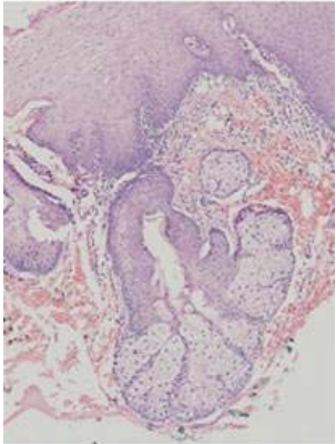 A. 乳頭瘤( papilloma ) B. 疣狀黃瘤( verruciform xanthoma )