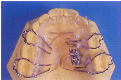  南斯氏裝置( Nance appliance ) 四環擴張器( quad helix )