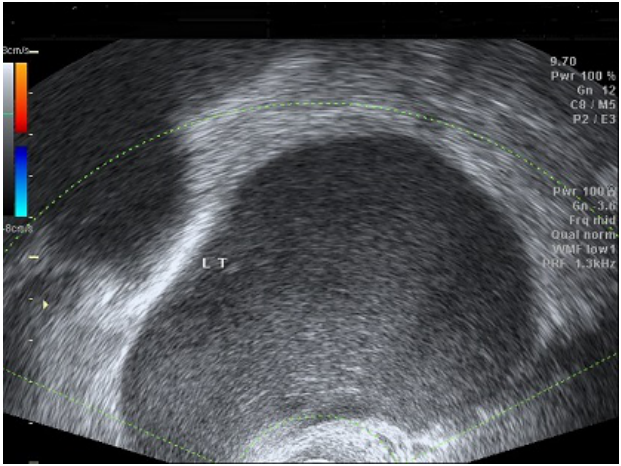 A. 卵巢濾泡囊腫( ovarian follicular cyst )