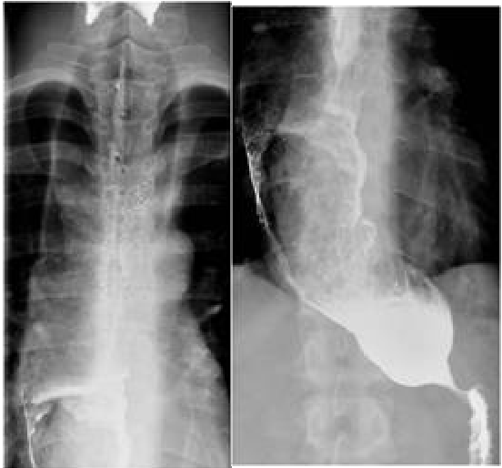 A.achalasia