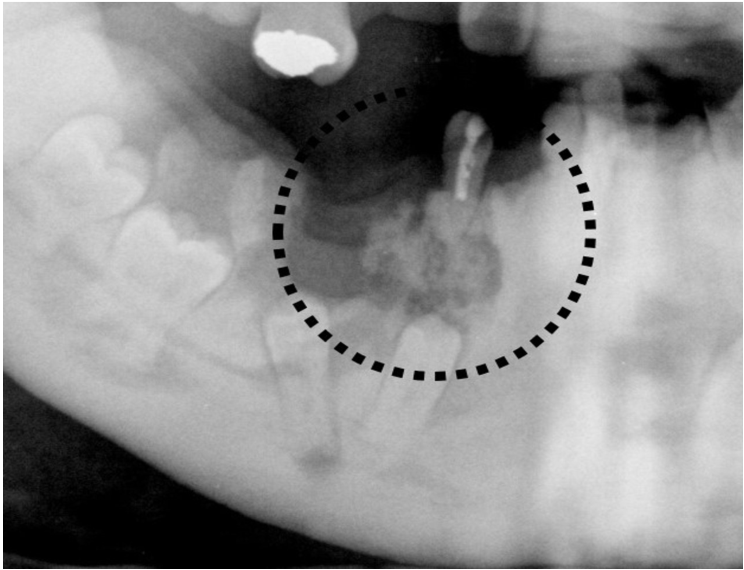A. 牙骨質骨化發育異常( cemento-osseous dysplasia )