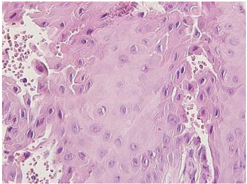  Darier-White disease ichthyosis