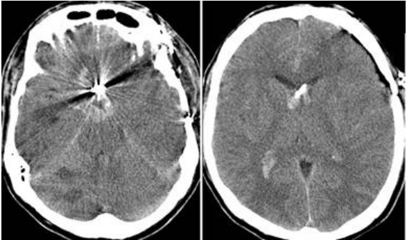  血管痙攣( vasospasm ) 再出血( rebleeding )