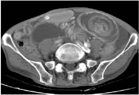  intussusception