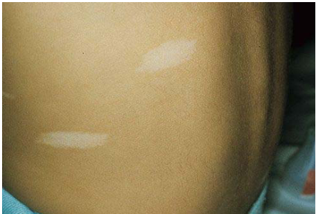  tuberous sclerosis neurocutaneous melanosis