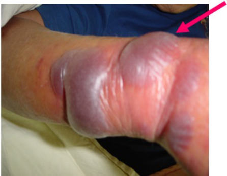  Vibrio vulnificus Klebsiella pneumoniae