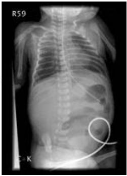  cytomegalovirus colitis acute gastroenteritis