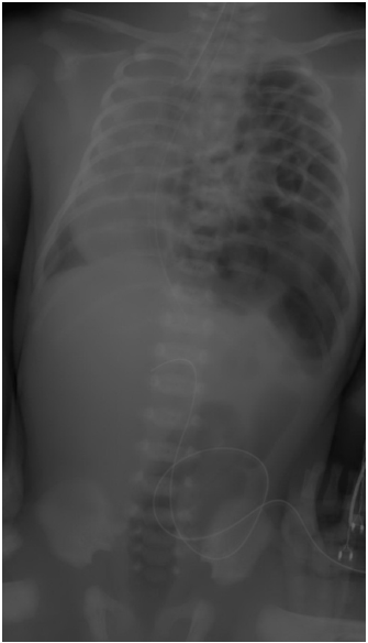 A. 橫膈疝脫( diaphragmatic hernia )