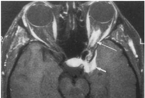 A. 視神經膠質瘤( optic nerve glioma )