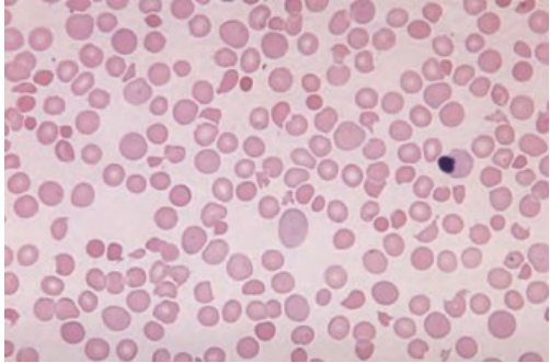 A.Thrombotic thrombocytopenic purpura