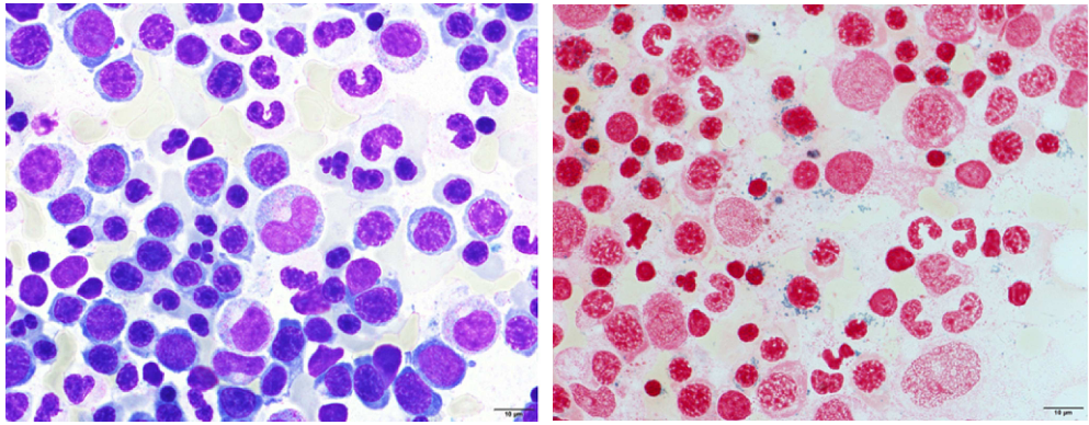 A.Plasmacytosis Liu's stain , Sideroblasts Iron stain