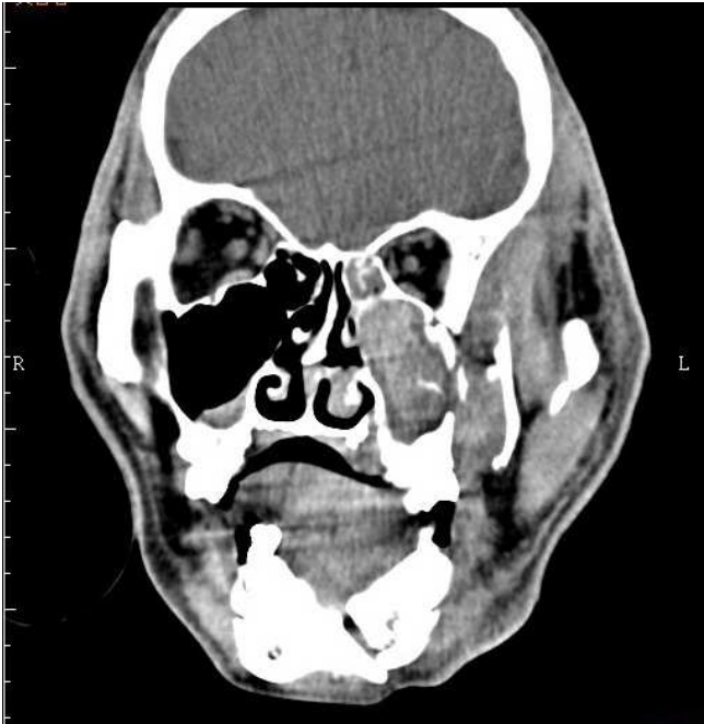 A. 左側上顎骨 comminuted fractrure 及下顎骨左側 fracture