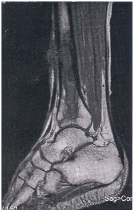  post-traumatic fracture of tibia chronic osteomyelitis with sinus tract of tibia