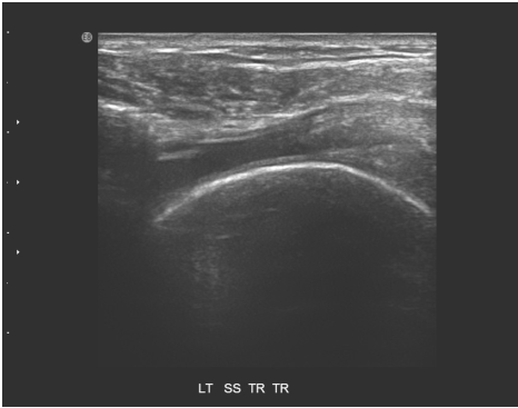 A. 風濕性關節炎( rheumatoid arthritis )