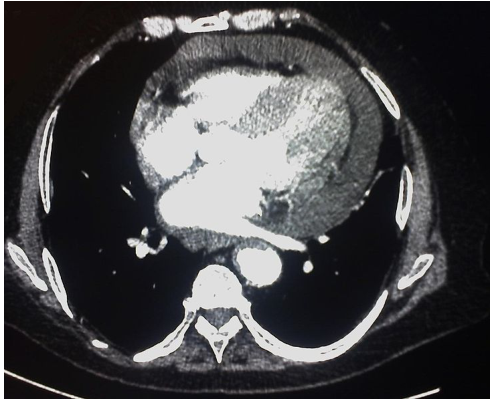  肥厚性心肌症( hypertrophic cardiomyopathy ) 主動脈剝離( aortic dissection )