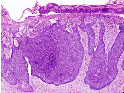  惡性黑色素細胞瘤( malignant melanoma ) 鱗狀細胞癌( squamous cell carcinoma )
